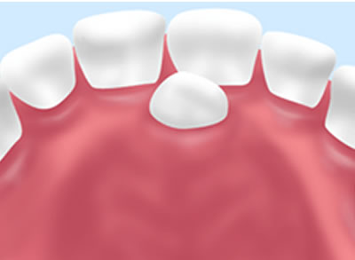 過剰歯の抜歯