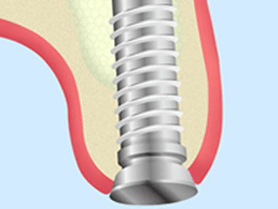 インプラント治療