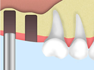 インプラント治療
