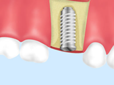 インプラント治療